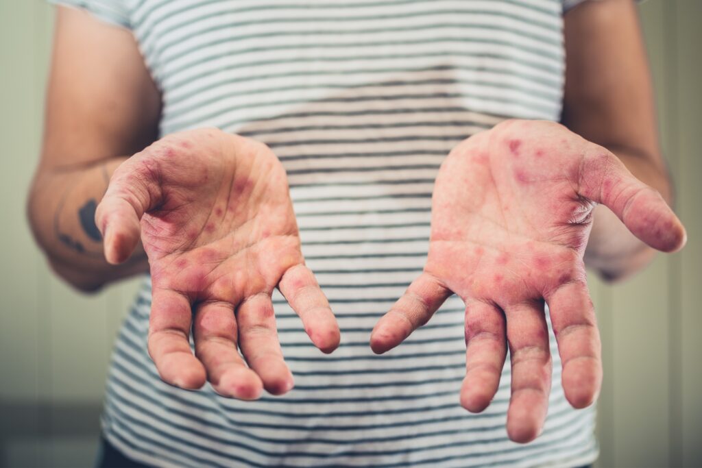 Understanding Hand-Foot-and-Mouth Disease_ Updated Prevention Strategies and the Most Effective Home Care Treatments