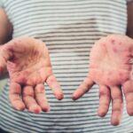 Understanding Hand-Foot-and-Mouth Disease_ Updated Prevention Strategies and the Most Effective Home Care Treatments